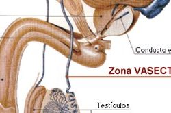 Ventajas y desventajas de vasectomia