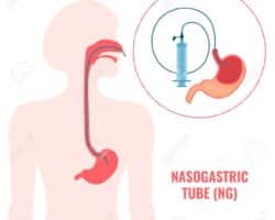 Ventajas y desventajas de la sonda nasogastrica