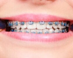 Ventajas y desventajas de los brackets autoligables