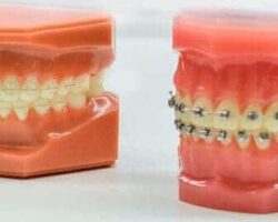 Ventajas y desventajas de los ortodoncistas de zafiro