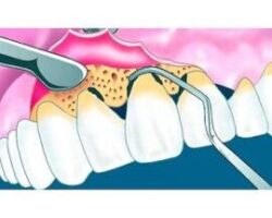 Ventajas y desventajas de la cirugía periodontal regenerativa