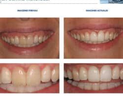 Ventajas y desventajas del blanqueamiento dental