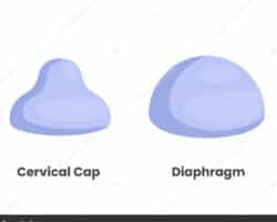 Ventajas y desventajas del diafragma cervical