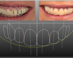 Ventajas y desventajas del diseño de sonrisa