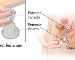 Ventajas y desventajas del método anticonceptivo de emergencia.