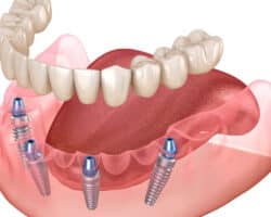 Ventajas y desventajas de las prótesis

Las prótesis son dispositivos creados con el propósito de reemplazar una parte del cuerpo que se ha perdido o que no funciona adecuadamente. Estas ofrecen diversas ventajas, pero también es importante tener en cuenta las desventajas que pueden presentar su uso. Entre las ventajas de las prótesis, encontramos la posibilidad de restaurar la funcionalidad y movilidad de una parte del cuerpo que se ha visto afectada por algún accidente, enfermedad o condición médica. Además, las prótesis pueden mejorar de forma significativa la calidad de vida de las personas, permitiéndoles realizar actividades diarias con mayor autonomía y comodidad. Sin embargo, también existen algunas desventajas asociadas al uso de las prótesis. En primer lugar, el proceso de adaptación a una prótesis puede ser complicado y requiere de tiempo y esfuerzo por parte del paciente. Además, las prótesis pueden generar ciertas incomodidades o molestias, especialmente durante los primeros días o semanas de uso. También es importante destacar que las prótesis pueden tener un costo