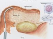 Ventajas y desventajas de la transferencia intratubárica de gametos