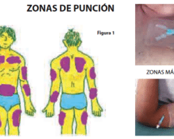 Ventajas y desventajas de la administración de medicamentos por vía subcutánea.