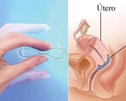 Ventajas y desventajas de los anticonceptivos intrauterinos.