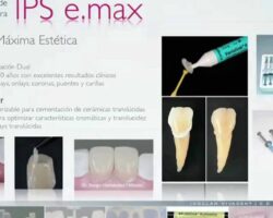 Ventajas y desventajas de la corona Emax