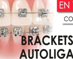 Ventajas y desventajas de los brackets autoligables.