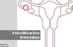 Ventajas y desventajas de la esterilización femenina y masculina.