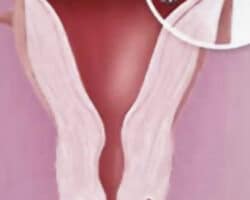 Ventajas y desventajas del método Essure.